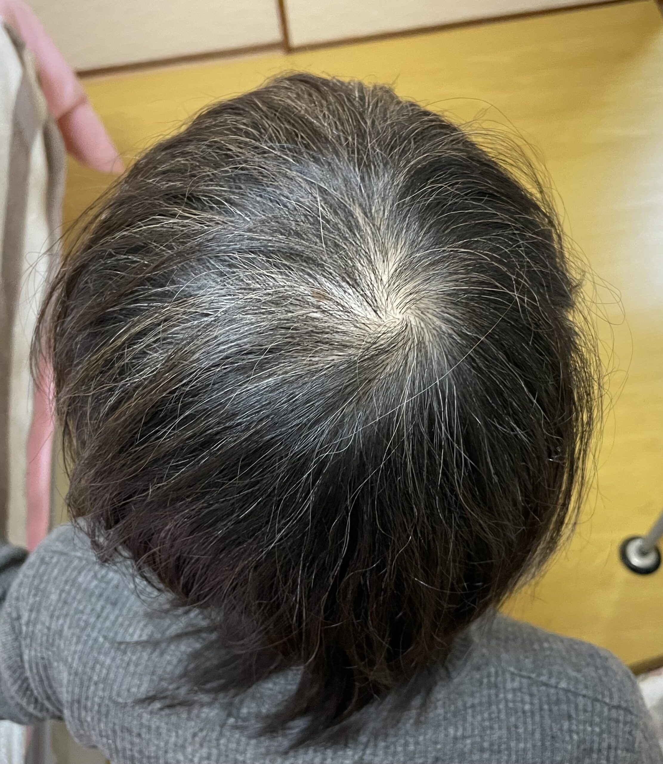 AGAコース施術中 2月15日の頭頂部の状態